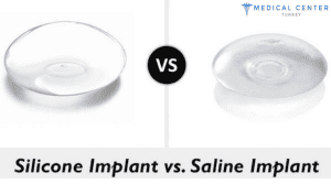 How Often Should Breast Implants Be Replaced