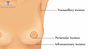 How Often Should Breast Implants Be Replaced