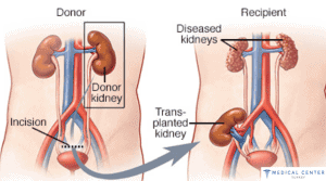 How Much Is a Kidney Transplant Surgery