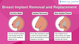 How Often Should Breast Implants Be Replaced