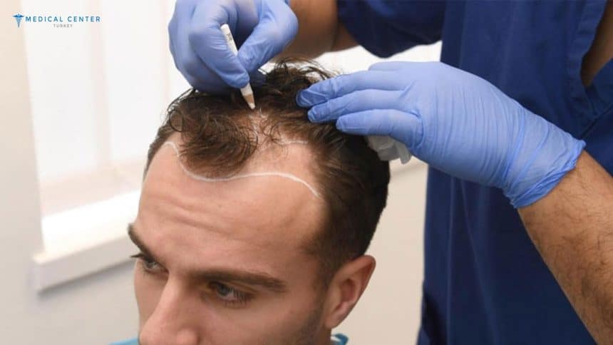 Hair Transplant Before and After Turkey