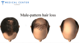 Hair Transplant Cost U.S. vs Turkey