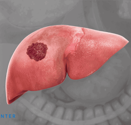 Liver Cancer Surgery Cost Liver Cancer Surgery Cost