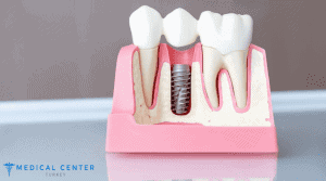 How Much Does an All On Four Dental Implant Cost