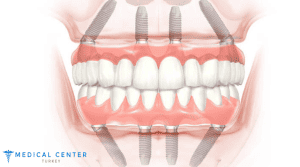 How Much Does an All On Four Dental Implant Cost