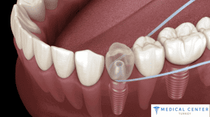 How Much Does an All On Four Dental Implant Cost