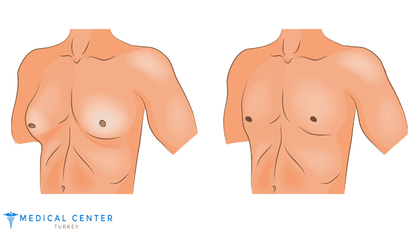 Gynecomastia Pinch Test