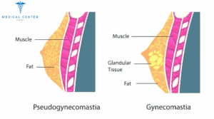 Gynecomastia Pinch Test