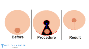 Gynecomastia Pinch Test