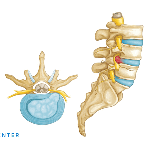 How Much Does Herniated Disc Surgery Cost How Much Does Herniated Disc Surgery Cost