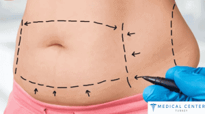 How Much Does Liposuction and A Tummy Tuck Cost