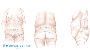 How Much Does Liposuction and A Tummy Tuck Cost