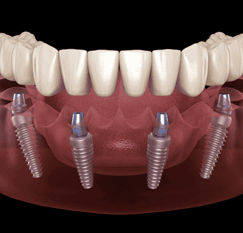 How Much Does an All On Four Dental Implant Cost