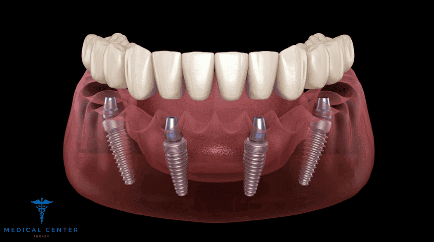 How Much Does an All On Four Dental Implant Cost
