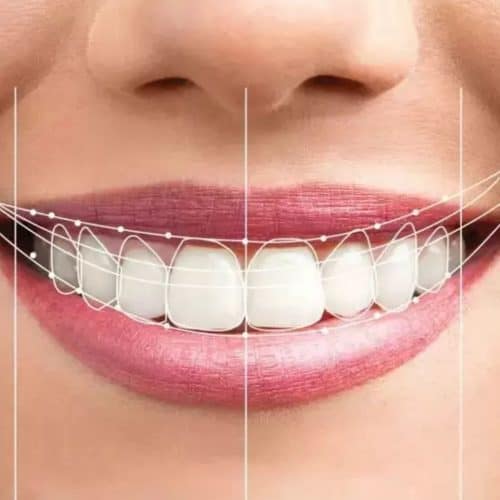Smile Makeover Cost in Turkey