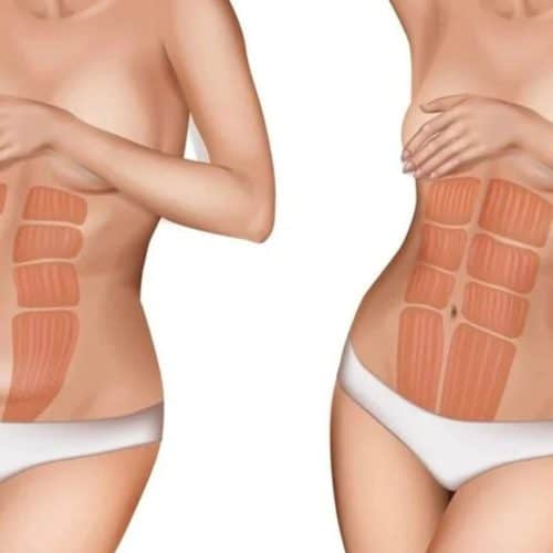 How Much Does Liposuction and A Tummy Tuck Cost