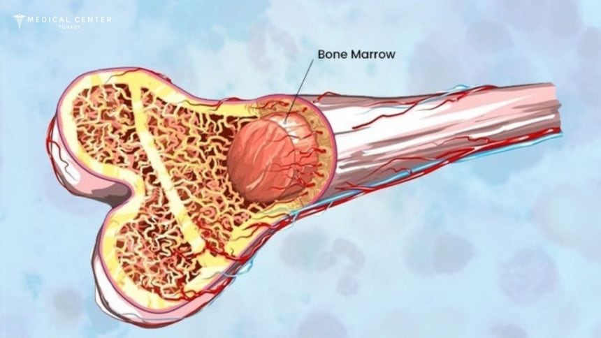 How Long is Bone Marrow Transplant? How Long is Bone Marrow Transplant?