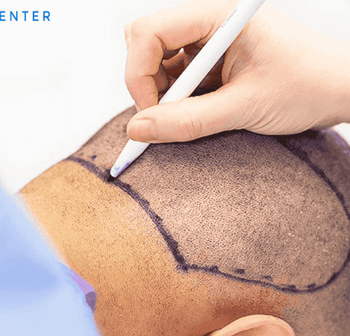 Cheapest Countries For Hair Transplant