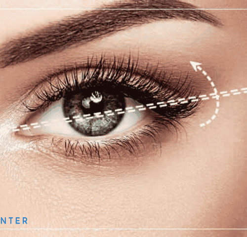 Almond Eyes Surgery Almond Eyes Surgery