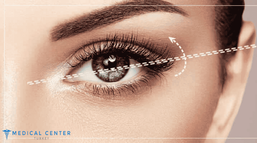 Almond Eyes Surgery Almond Eyes Surgery