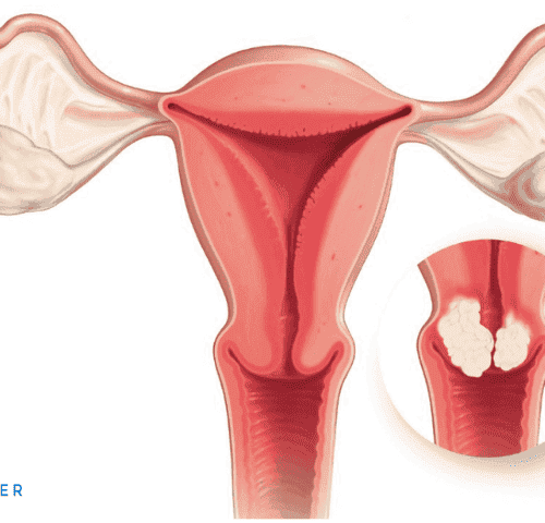 How Much Does Cervical Cancer Treatment Cost How Much Does Cervical Cancer Treatment Cost