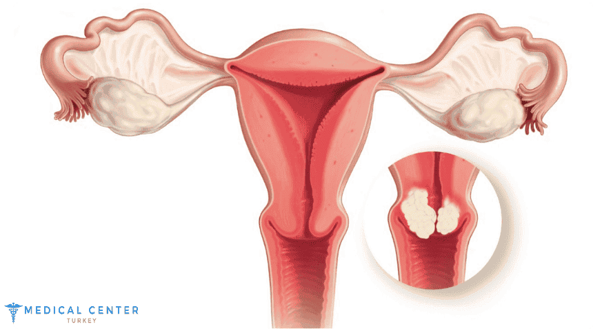 How Much Does Cervical Cancer Treatment Cost
