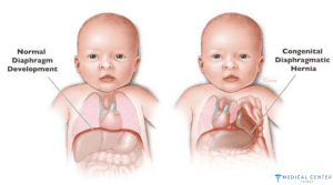 How To get Hernia Surgery Without Insurance