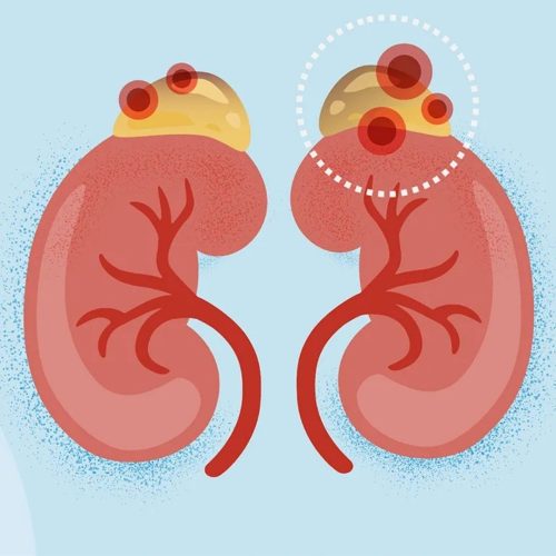 What Is Adrenal Cancer and How It Is Treated? What Is Adrenal Cancer and How It Is Treated?