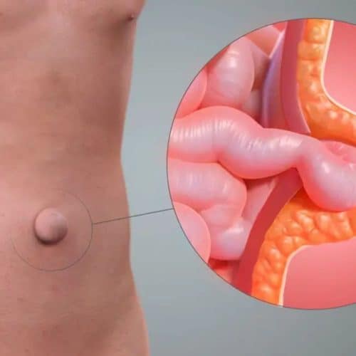 How To Get Hernia Surgery Without Insurance How To Get Hernia Surgery Without Insurance