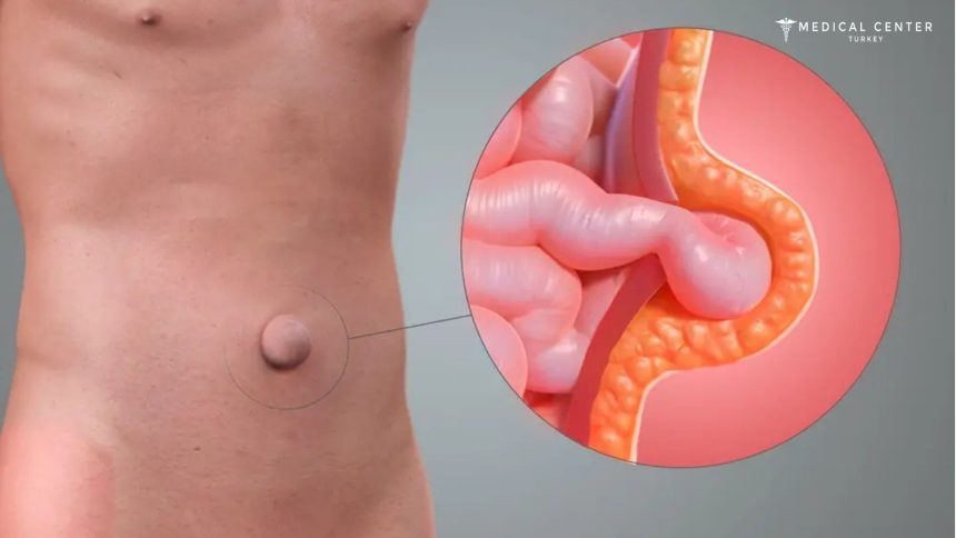 How To Get Hernia Surgery Without Insurance