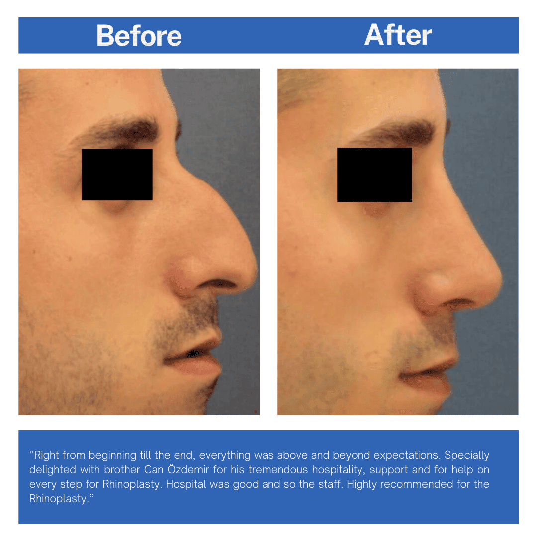 Rhinoplast (Nose Job) Before and After Turkey