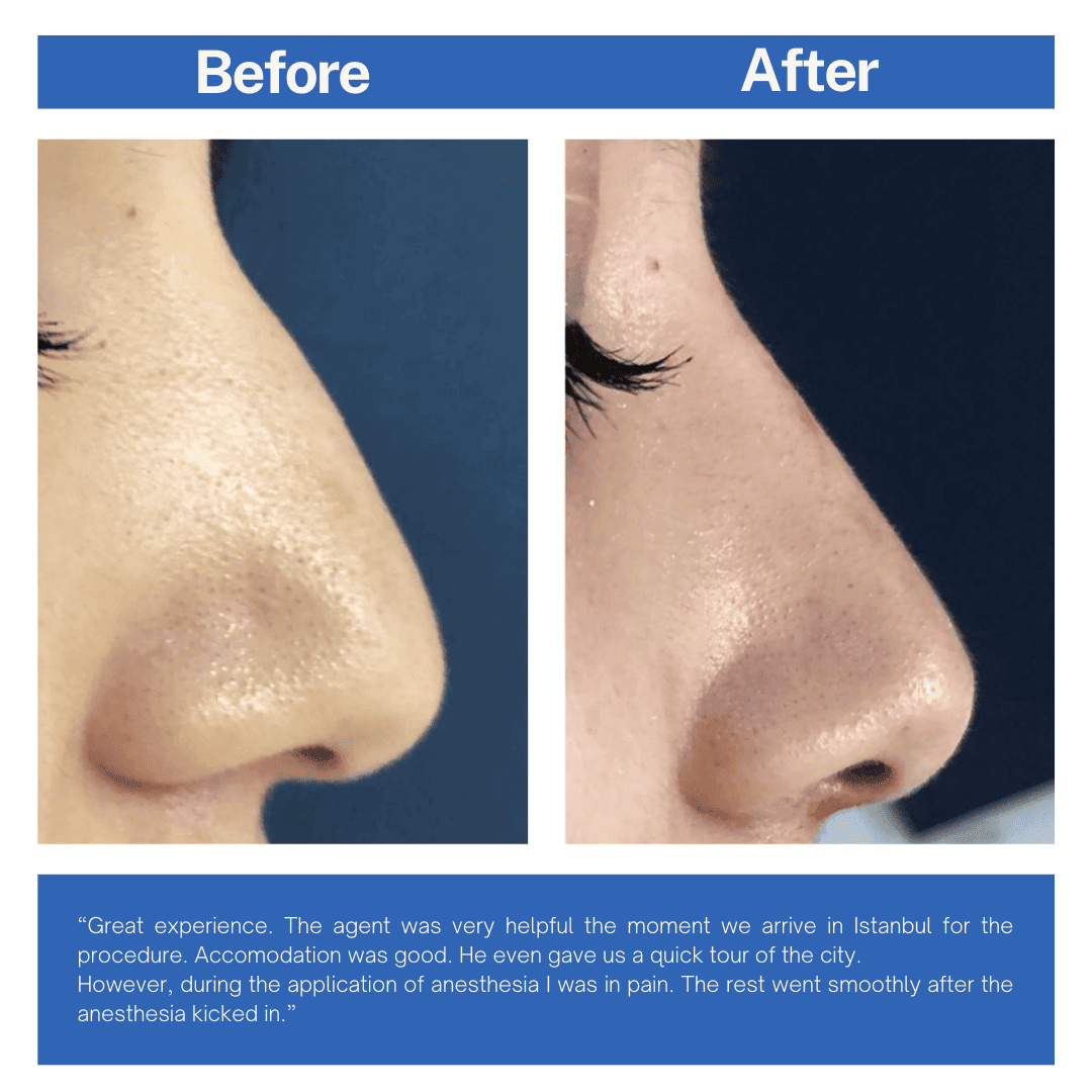 Rhinoplast (Nose Job) Before and After Turkey