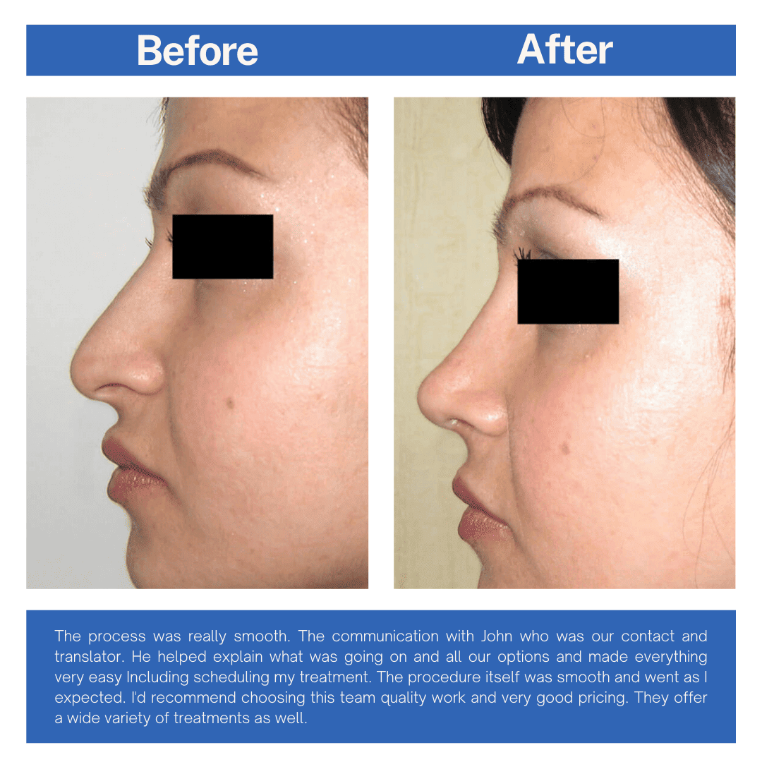 Rhinoplast (Nose Job) Before and After Turkey