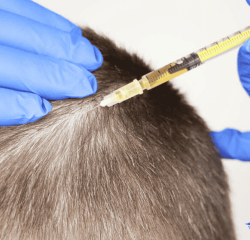 Hair Treatment Mesotherapy