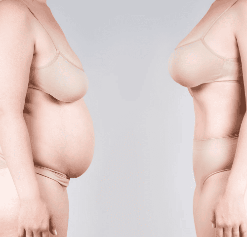 How Much Is A Mommy Makeover How Much Is A Mommy Makeover