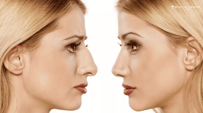Rhinoplast (Nose Job) Before and After