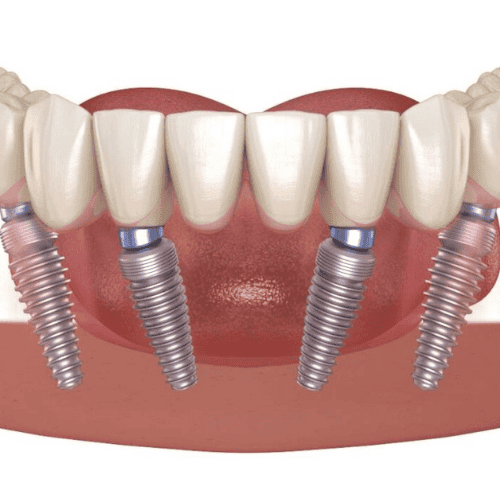 Dental Implants Cheapest Country