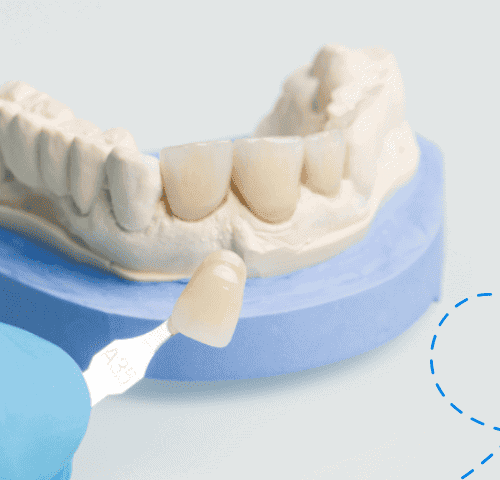 The 9 Best Countries for Veneers