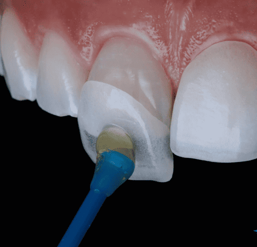 How Long Do Veneers Last?