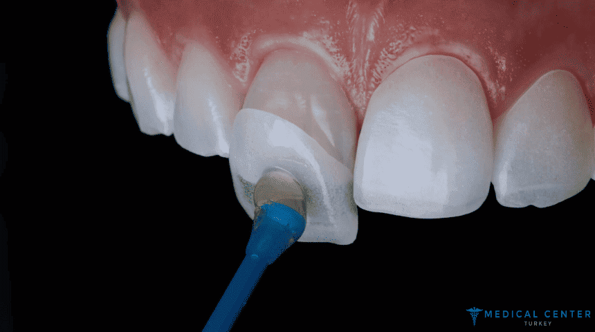 How Long Do Veneers Last?