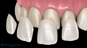How Long Do Veneers Last?