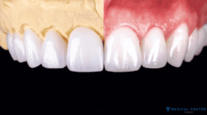 How Long Do Veneers Last?