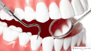 How Long Do Veneers Last?