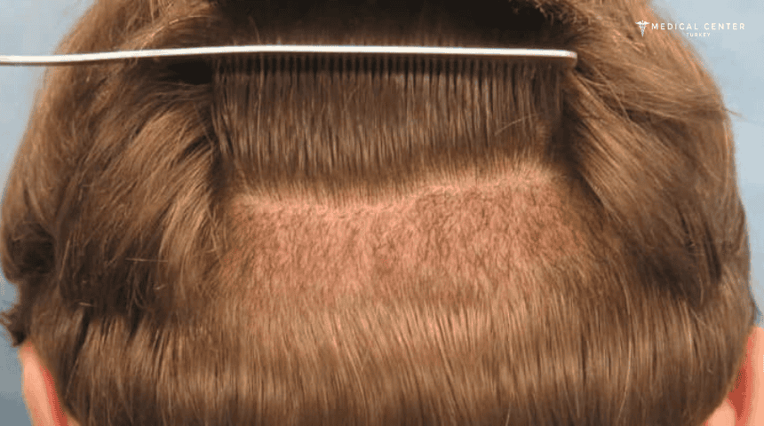 A Guide to Hair Transplant Success Rates