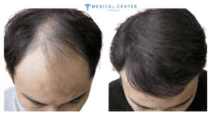 A guide to stem cell hair transplants