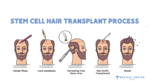 A guide to stem cell hair transplants