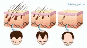 A guide to stem cell hair transplants 