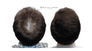 A guide to stem cell hair transplants