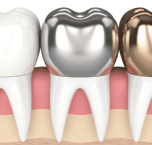 How Long Does a Dental Crown Last?