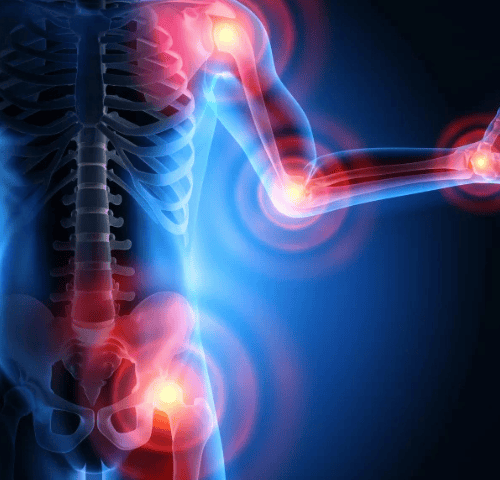 How is spinal osteoarthritis treated in Turkey? How is spinal osteoarthritis treated in Turkey?